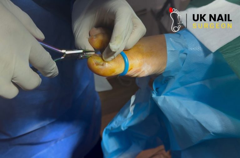 Relieve toe pain: expert help for ingrown nails in Birmingham