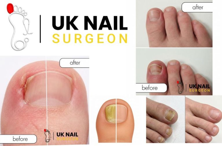 Relief and care after nail edge removal: practical guidance Relief and care after nail edge removal: practical guidance