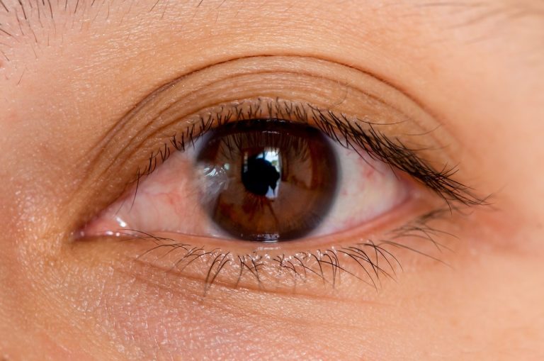 Pterygium removal: what to expect and how to choose the right approach